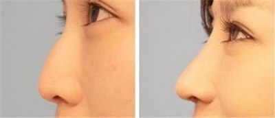 长沙做鼻综合(长沙的鼻综合手术：拒绝一张脸的标准)