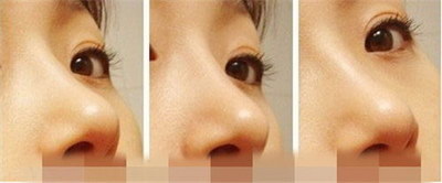 当我们的鼻子有些歪着的时候，要怎么矫正呢？