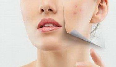 最快最有效的方法去除痘痘_用硫磺皂洗脸可以去除痘痘