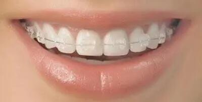 牙龈和牙齿之间有黑色的硬石(如何去除牙龈和牙齿之间的黑色硬石？)