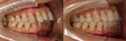 牙龈导致的牙齿松动(牙齿松动导致牙龈肿)