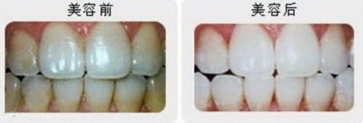 牙齿为什么会有黑色洞_牙齿上有裂纹怎么修复比较好