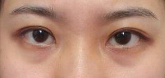 眼底长斑是什么原因导致的_怎样去除眼角和眼底皱纹