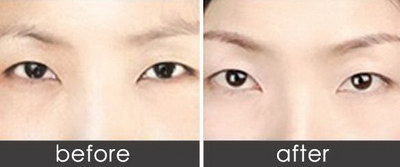 做埋线双眼皮手术在杭州做效果好不好呢？