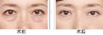 双眼皮恢复期要多久(双眼皮手术后的恢复期)