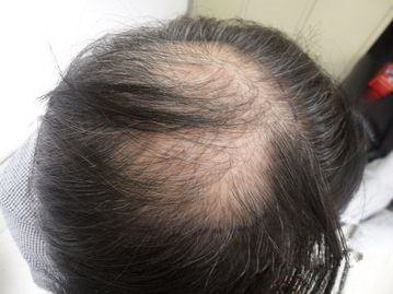 植发后的头发大概多久才能自然生长出来(植发后大概多久开始长头发)