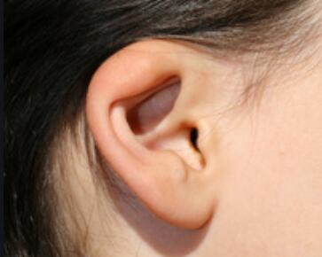 矫正耳朵外形_夹耳朵能提升面部皮肤吗