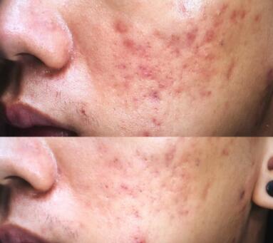 敷完面膜不洗脸对皮肤有什么伤害吗